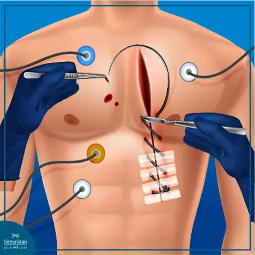 Open Heart Surgery In Cardiovascular Surgery Centers In Turkey