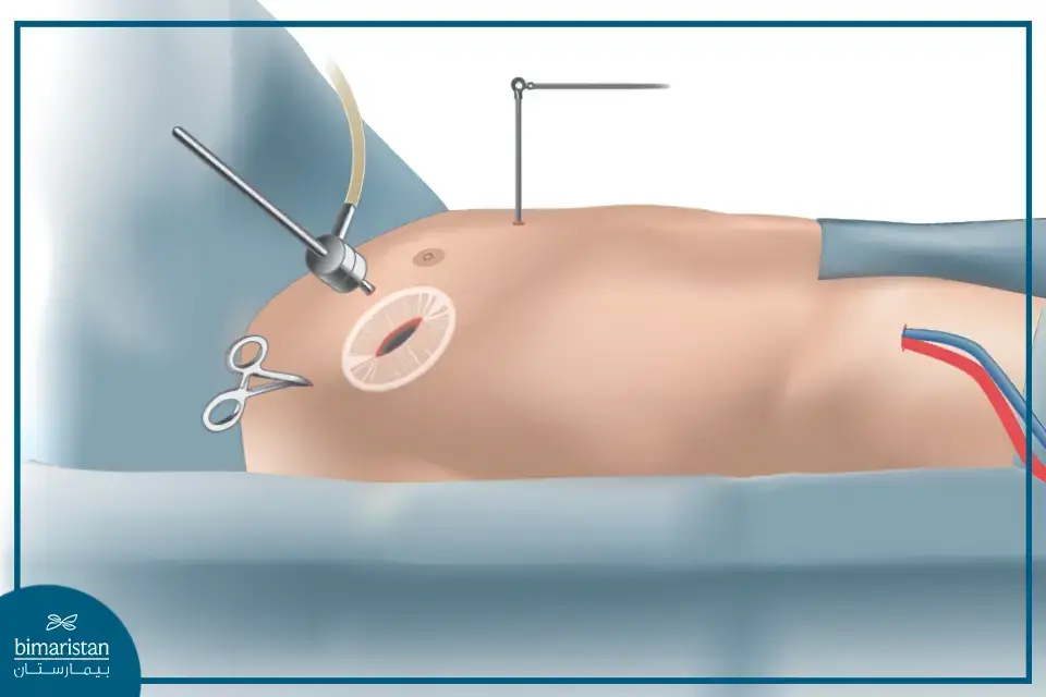 Laparoscopic Heart Surgery