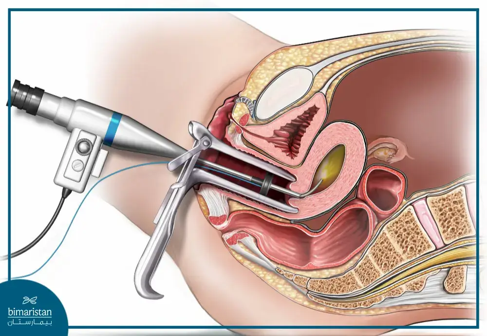 عملية منظار الرحم في مراكز النسائية والتوليد في تركيا