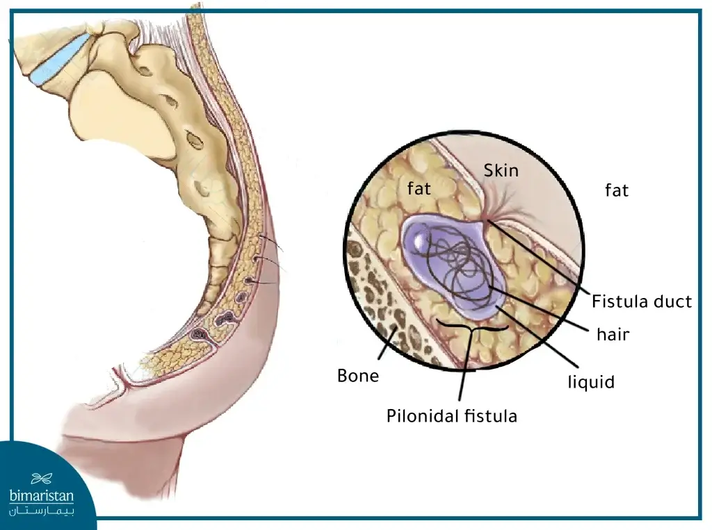 A Picture Showing The Pilonidal Cyst Surgery , Its Components, And In Which Layer Of Skin It Usually Arises