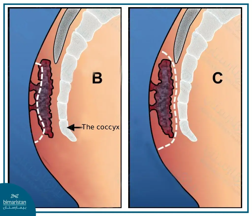 An Image Showing The Types Of Pilonidal Cyst Surgery