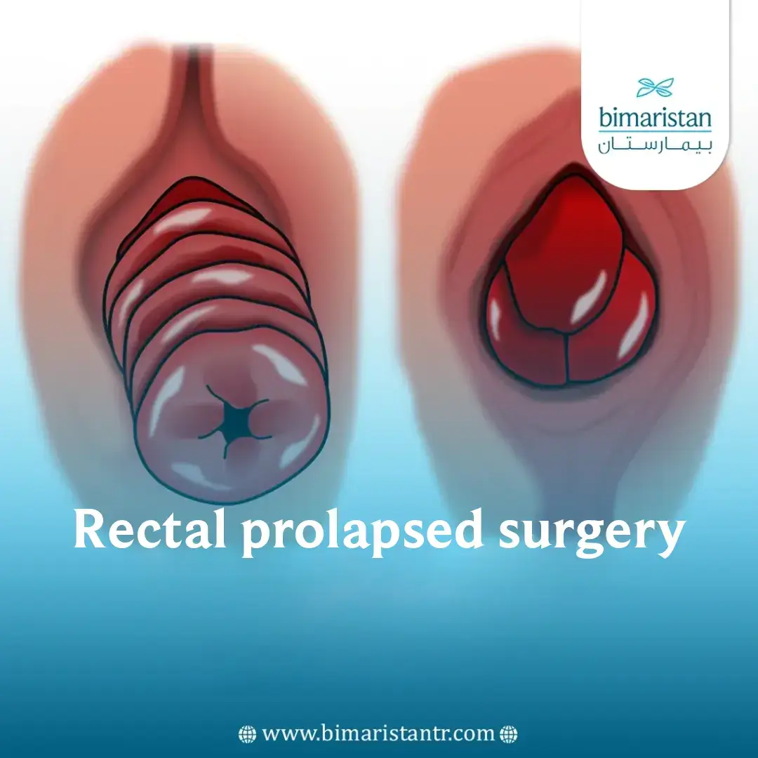 Rectal Prolapse Repair In Turkey
