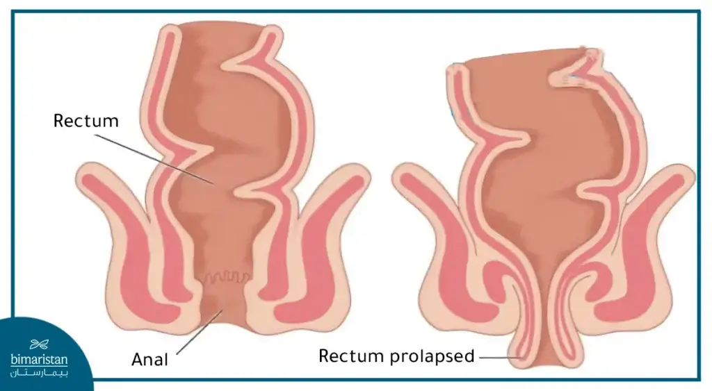 Rectal Prolapse Surgery