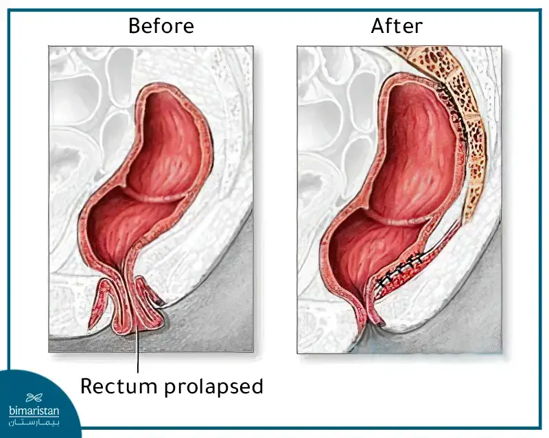 Comparison Between The Condition Of Rectal Prolapse And The Normal Condition After Rectal Prolapse Repair