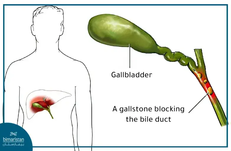 This Image Shows The Presence Of A Gallstone Blocking The Bile Duct, Which Requires Surgery To Perform Gallstone Lithotripsy To Relieve Symptoms.