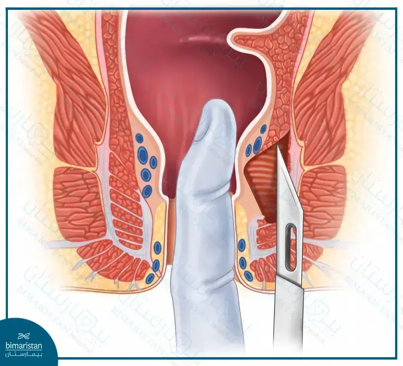 Lateral Internal Sphincterotomy Is Considered The Final Solution For Chronic Anal Fissure Treatment