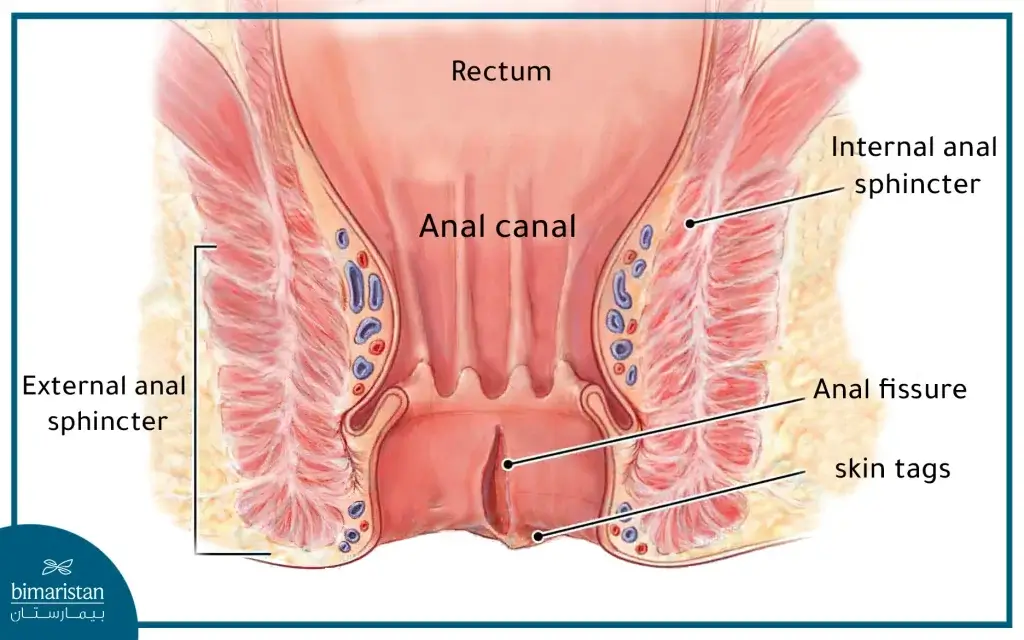 Anal Fissure In The Anal Canal With Skin Tags At The Anus