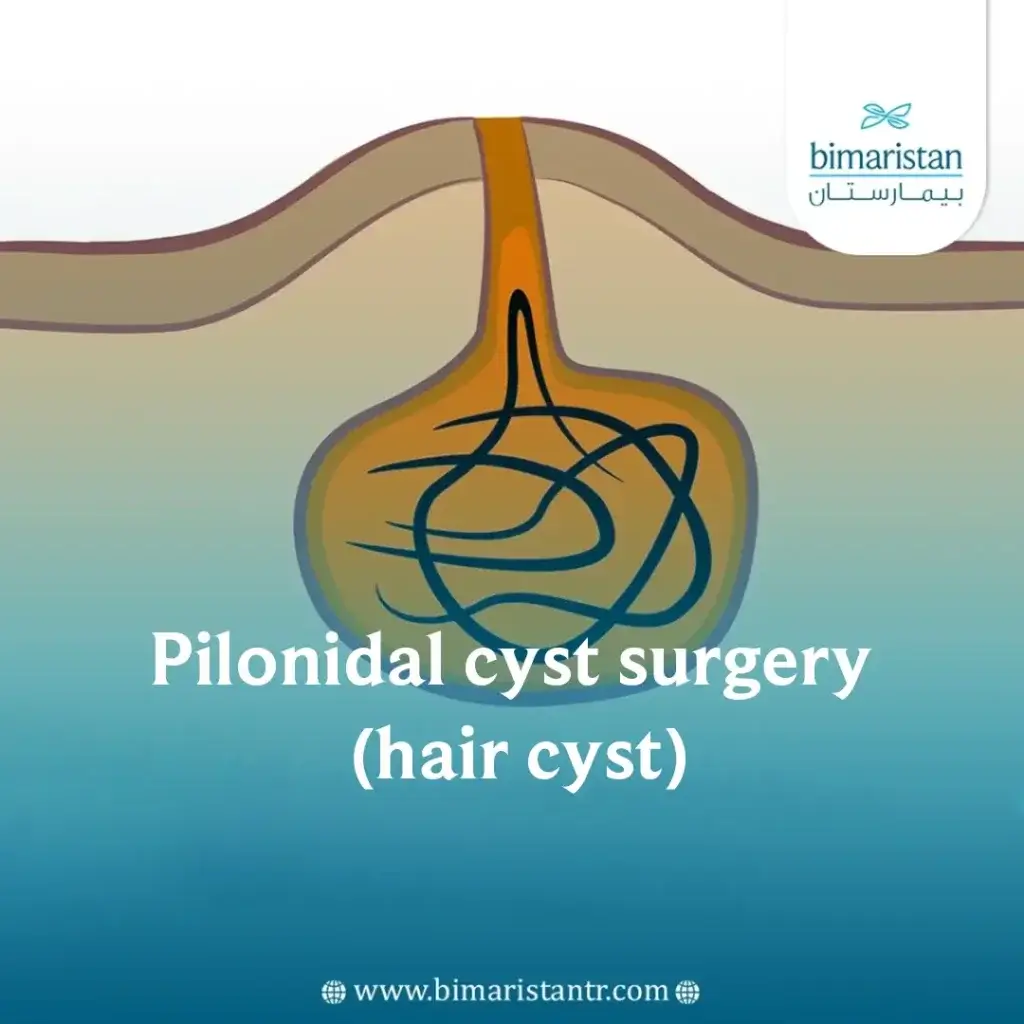 Pilonidal Cyst Surgery In Turkey Effective Treatment