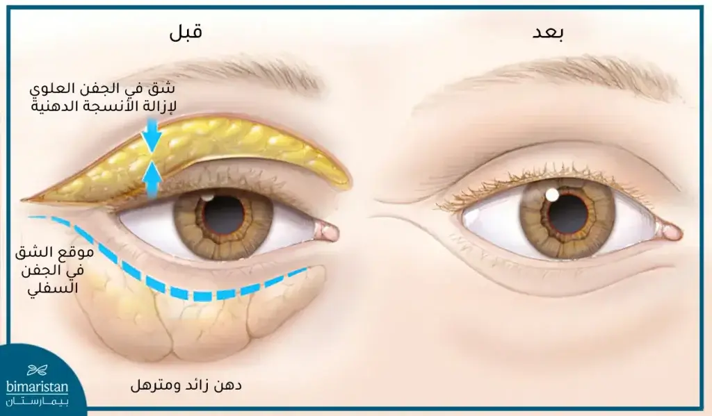 عملية شد الجفون في قسم الجراحة التجميلية والترميمية