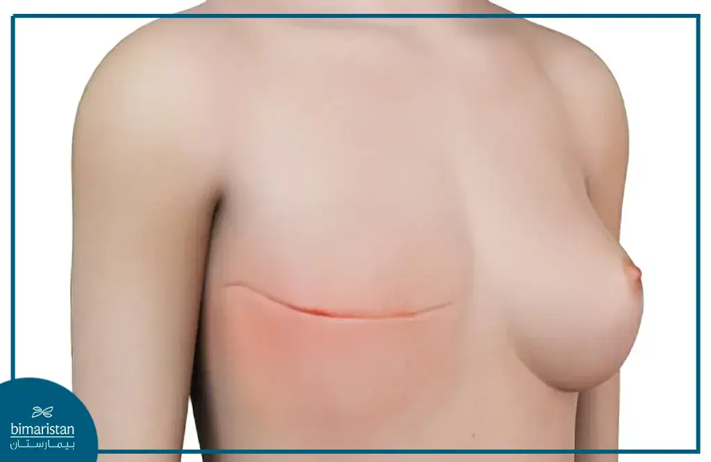 The Chest Of A Patient With Breast Cancer Who Underwent A Total Mastectomy