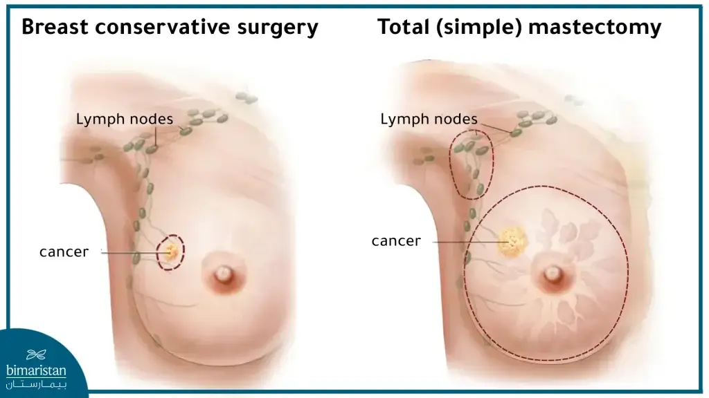 Conservative Surgery Is Characterized By The Ability To Remove The Tumor While Preserving The Breast Tissue And Phlegm Nodules