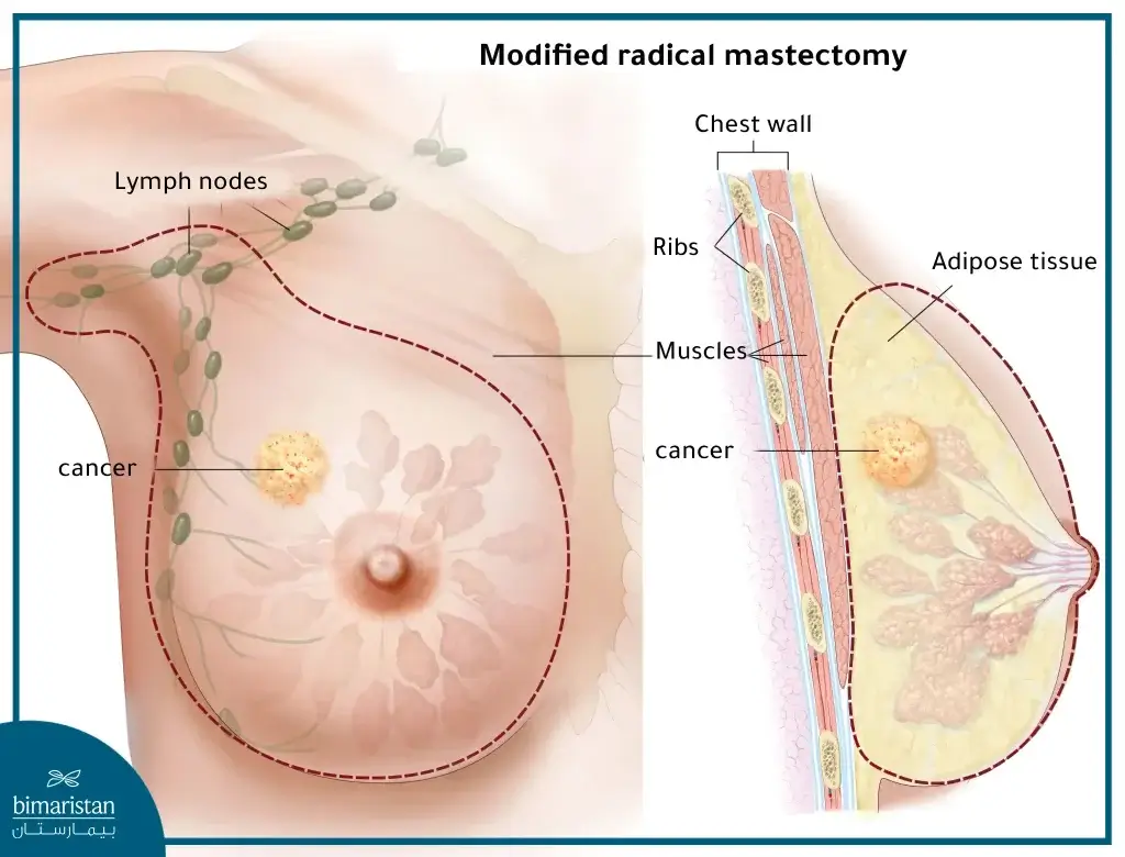 In A Modified Radical Mastectomy, The Entire Breast Tissue Is Removed Along With The Axillary Phlegmatic Nodes