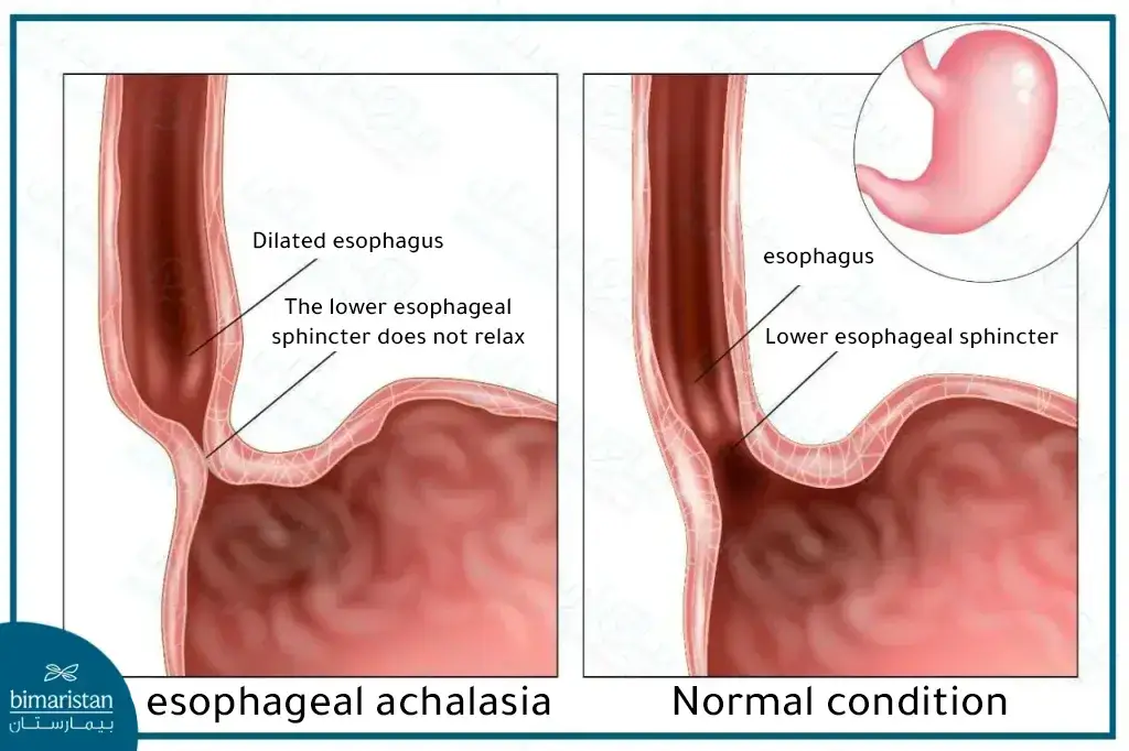 Esophageal Achalasia And Normal Esophagus