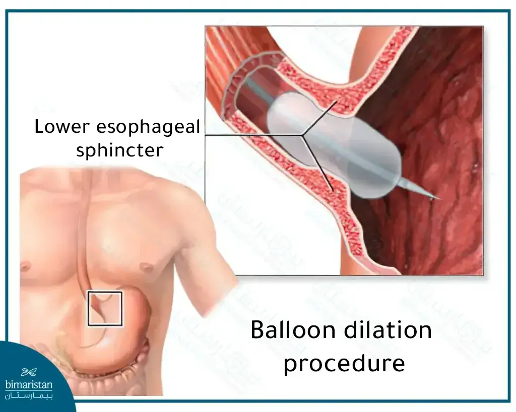 Treatment Of Achalasia Through Balloon Dilatation