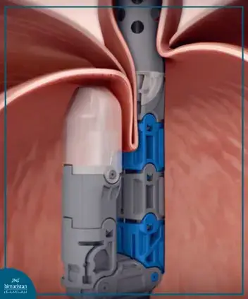Transoral Fundoplication (Tif), Which Is Performed Without Making Surgical Incisions, Is Entered Through The Mouth And Then The Fundus Is Folded Around The Esophageal Sphincter Using An Advanced Device, As It Is Considered One Of The Modern Methods Of Treating Esophageal Reflux In Turkey.