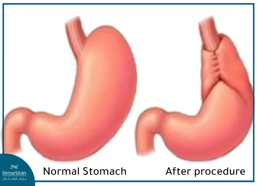 Nissen Procedure, Which Is Used For Gerd Treatment By Bending The Upper Part Of The Stomach Around The Lower Esophageal Sphincter, Which Increases The Pressure Of The Lower Esophageal Sphincter And Prevents Reflux.
