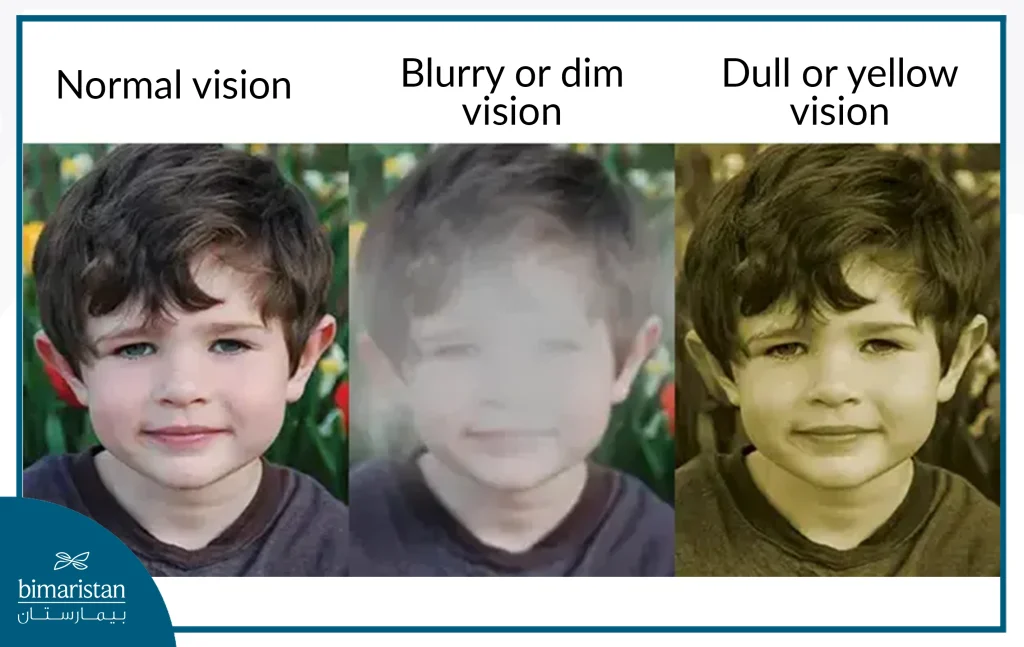 Symptoms Of Eye Cataracts