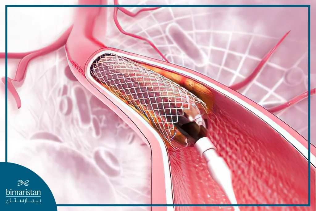 A Stent Is Placed In The Narrowed Coronary Artery Using A Catheter