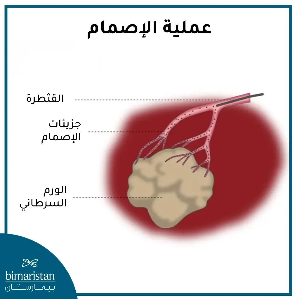 الدليل الشامل لعلاج أمراض السرطان في تركيا 3 الإصمام الكیمیائي عبر الشرایین (Tace)
