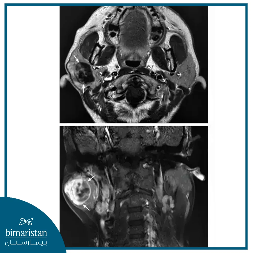 A Skull Mri Of A Patient With Salivary Gland Cancer In Turkey Showed A Mass In The Parotid Gland.