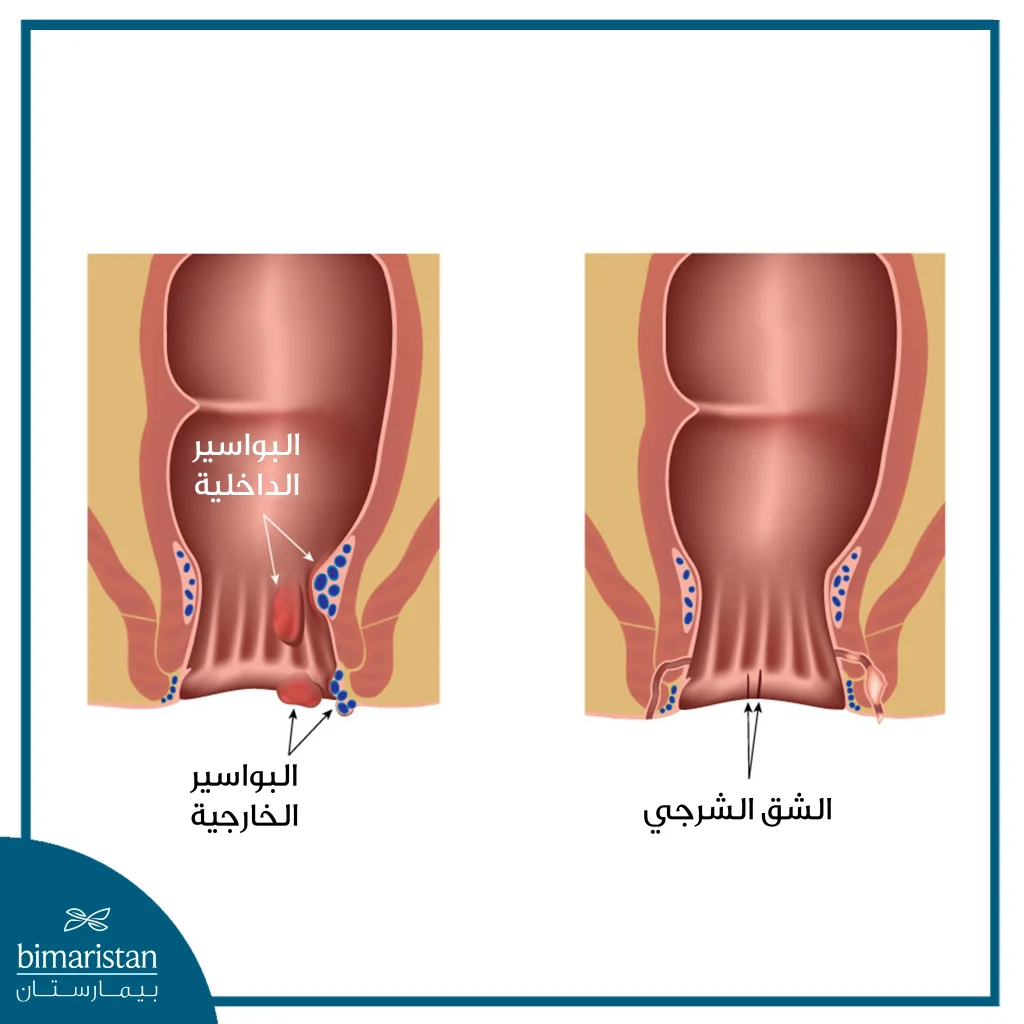 الفرق بين الشق الشرجي والبواسير