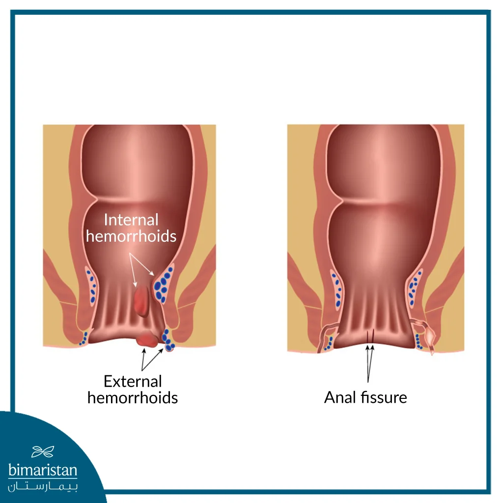 The Difference Between Anal Fissure And Hemorrhoids