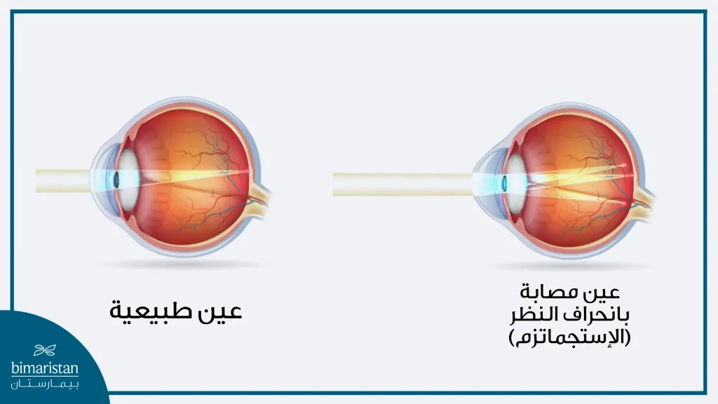 الدليل الشامل لعلاج أمراض العيون في تركيا 2 الفرق في الرؤية بين العين الطبيعية والعين المصابة بانحراف النظر