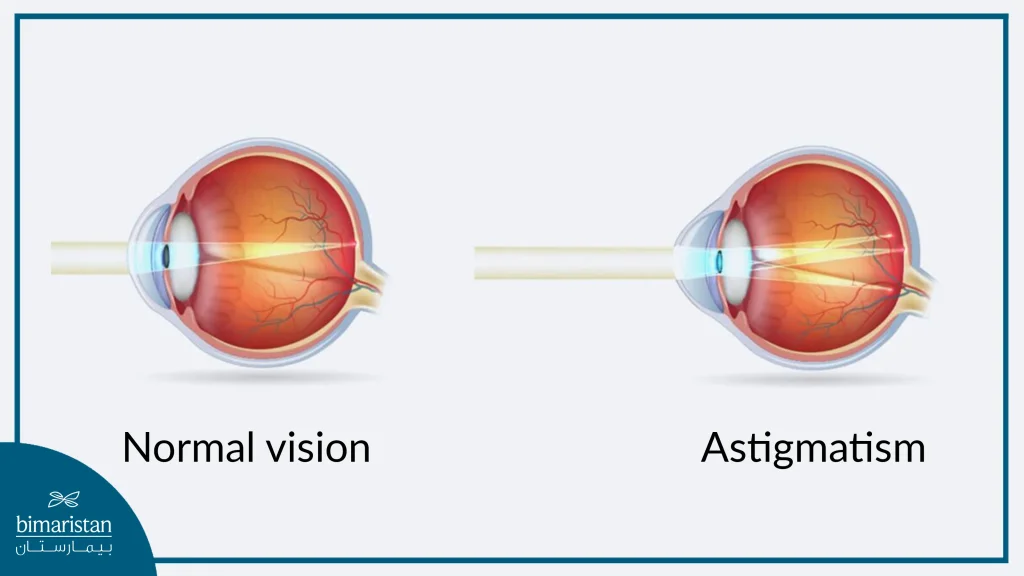A Comprehensive Guide To Treating Eye Diseases In Turkey 2 The Difference In Vision Between A Normal Eye And An Eye Affected By Astigmatism