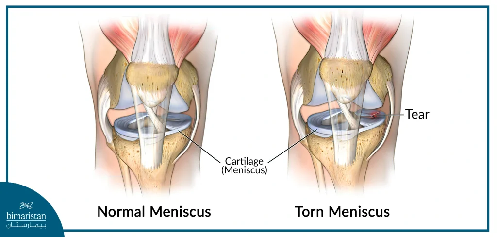 Knee Cartilage Tear In Images 