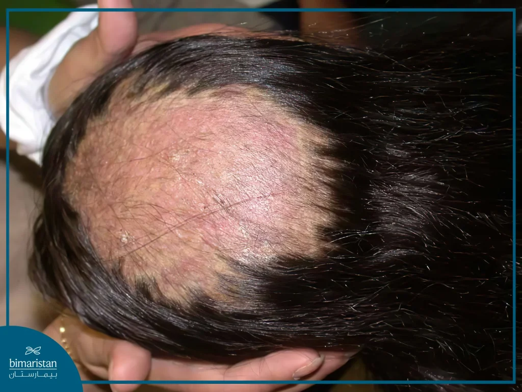 Image Of Alopecia Areata, One Of The Reasons Of Hair Loss In Women