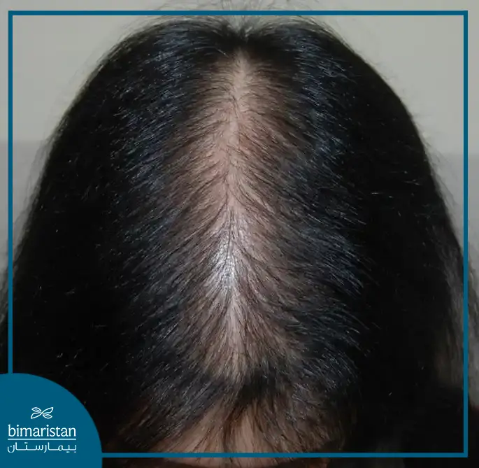 Image Of Androgenic Alopecia