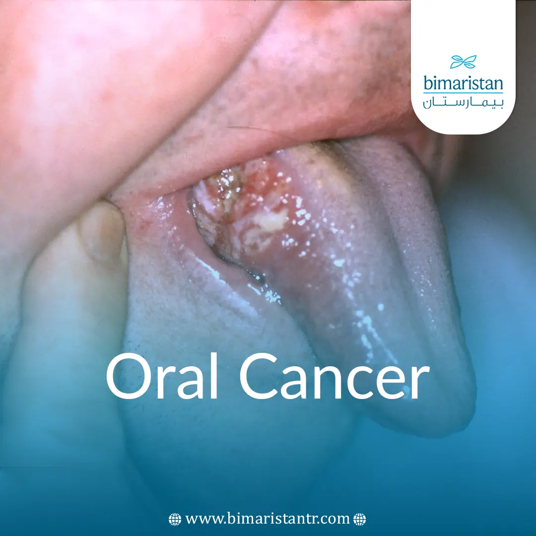 Oral Cancer Causes, Diagnosis, and Treatment in Turkey