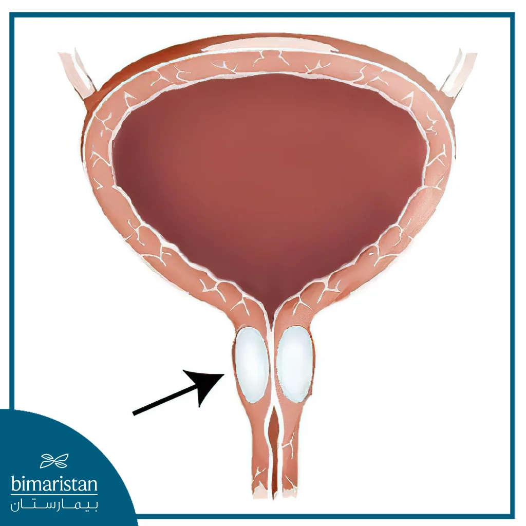 A Thickening Substance Such As Silicone Is Injected To Keep The Urethra Closed