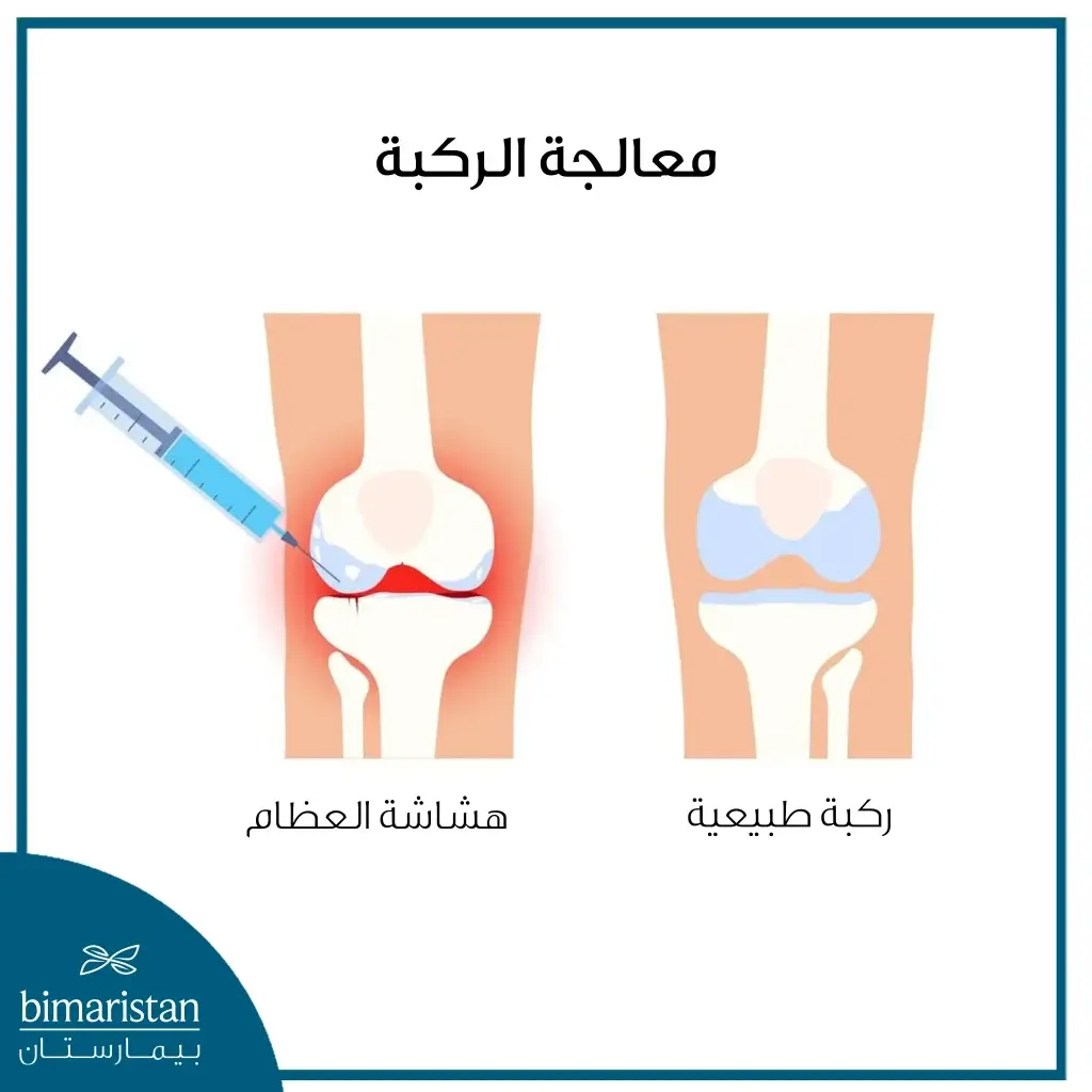 حقن الهيالورونيك أسيد في الركبة لمعالجة ألم هشاشة العظام