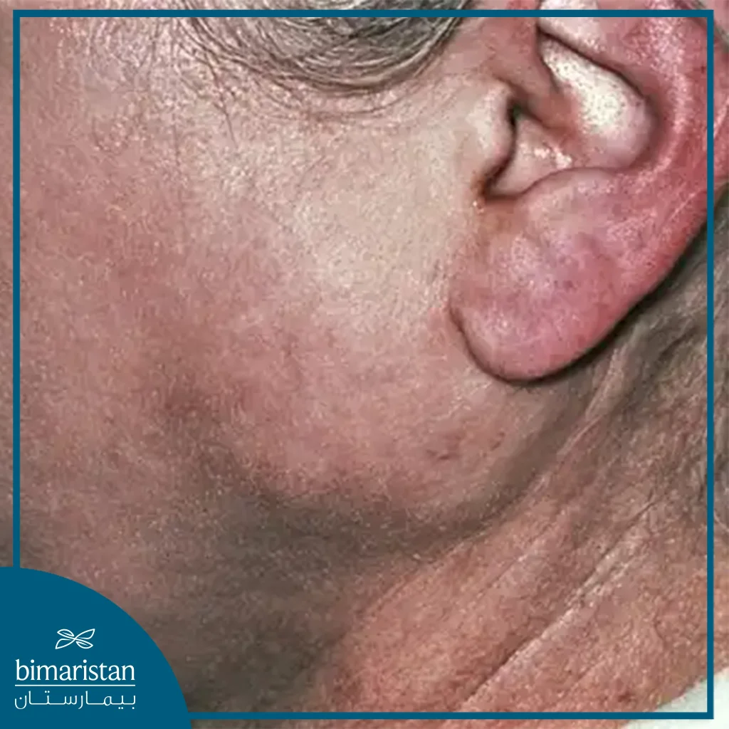 We Notice The Presence Of Swelling Below And In Front Of The Ear, Which May Indicate The Presence Of A Tumor In The Parotid Gland.