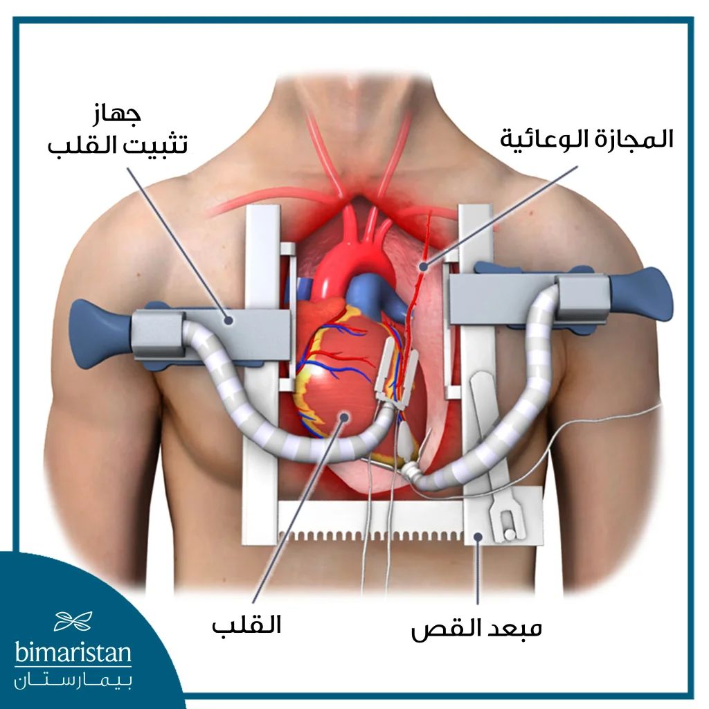 قد لا تحتاج بعض عمليات المجازة الشريانية التاجية إلى استخدام مضخة القلب