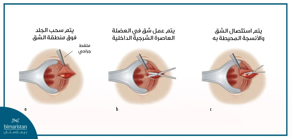 جراحة الشق الشرجي