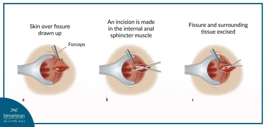 Anal Fissure Surgery