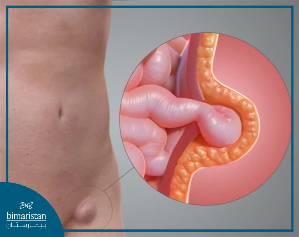 Image Showing An Umbilical Hernia And The Exit Of Loops Of Intestine Through The Hernia