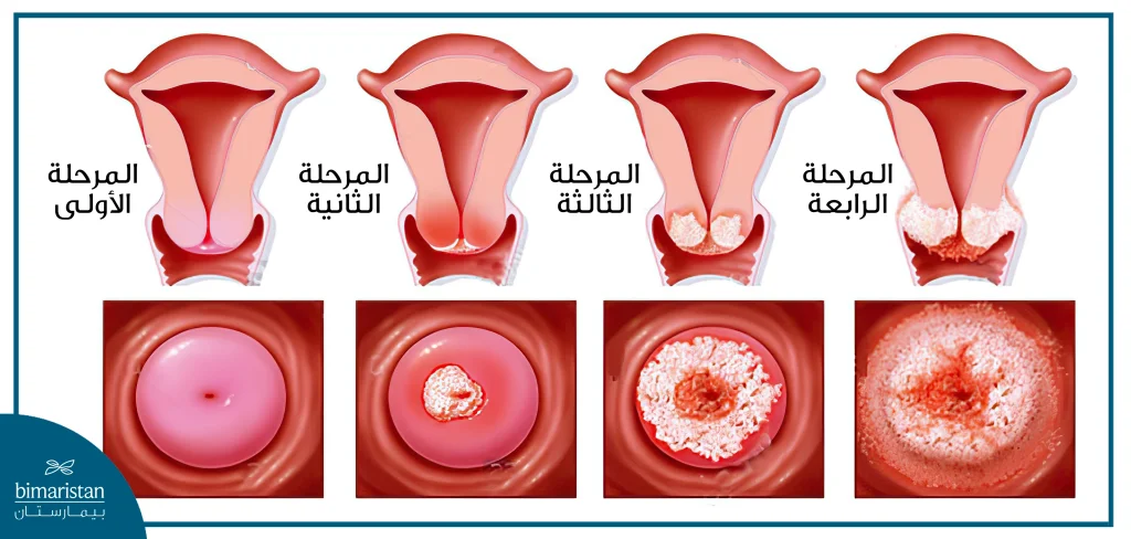 مراحل سرطان العنق الرحمي وشكل عنق الرحم في كل مرحلة