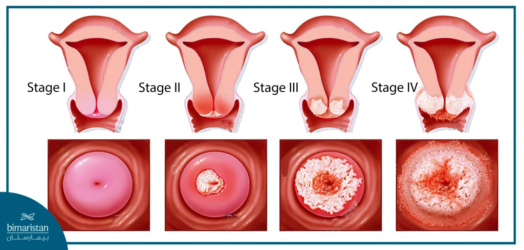 Stages Of Cervical Cancer And The Shape Of The Cervix At Each Stage