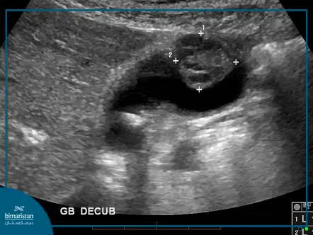 Diagnosis Of Gallbladder Cancer By Ultrasound Imaging (Echography)