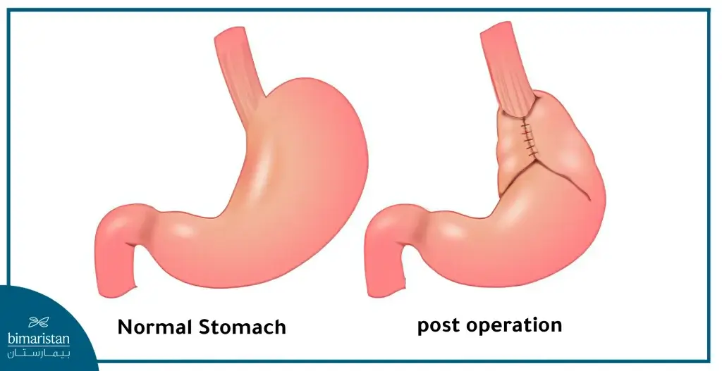 Nissen Procedure, Which Is Used To Treat Gastroesophageal Reflux Disease, Is Done By Bending The Upper Part Of The Stomach Around The Lower Esophageal Sphincter, Which Increases The Pressure Of The Lower Esophageal Sphincter And Prevents Reflux.