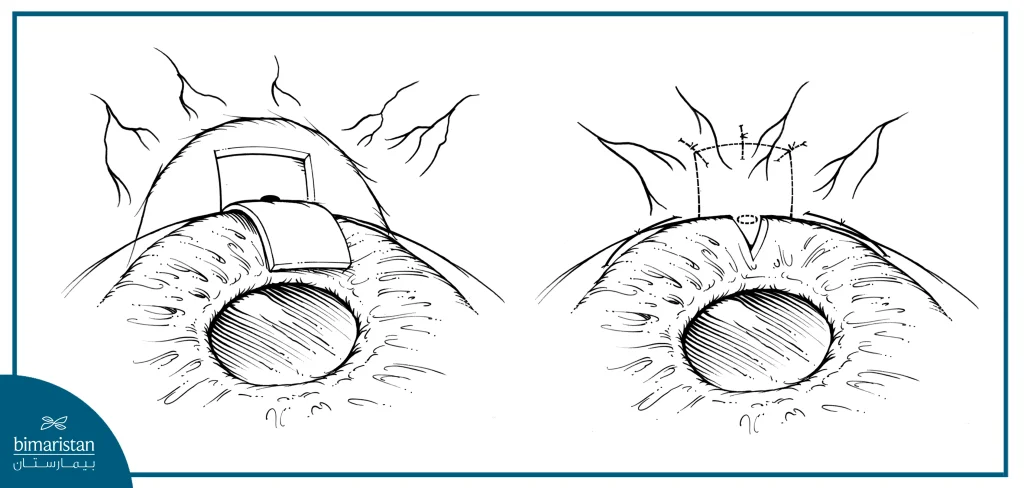 Image Showing Trabeculectomy