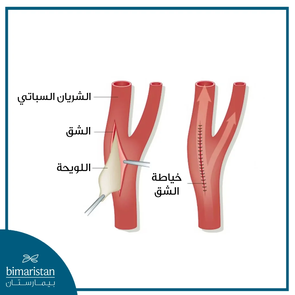 استئصال باطنة الشريان السباتي في تركيا