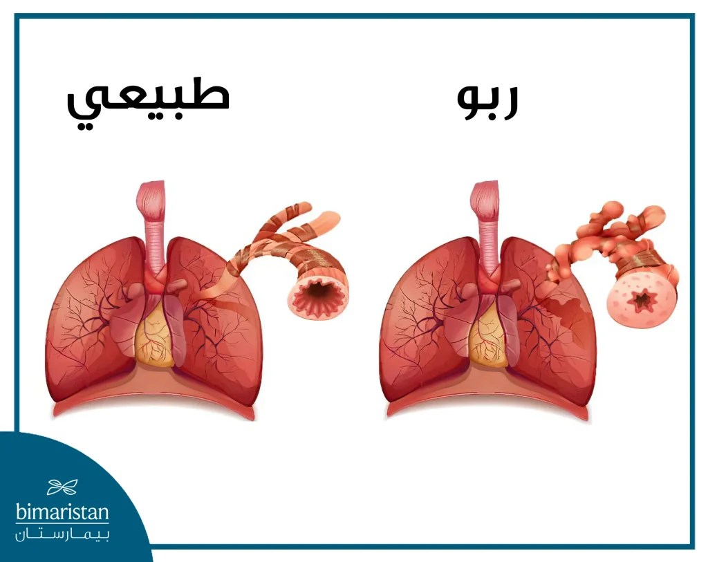 صورة تظهر تضيق القصبات عند مريض الربو بالمقارنة مع شخص طبيعي غير مصاب بالربو