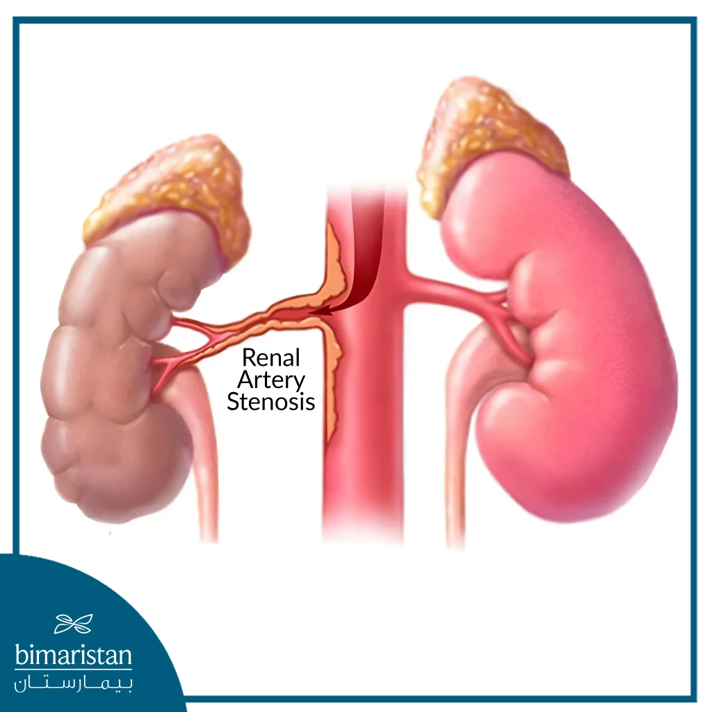 Multiple Sclerosis Can Cause The Renal Artery To Narrow, Limiting Blood Flow To The Kidney