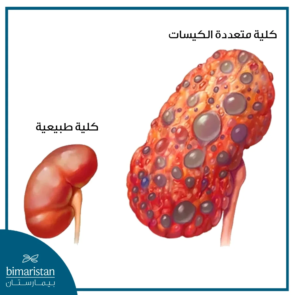 صورة تتحدث عن الكلية متعددة الكيسات التي قد تسبب أعراض الفشل الكلوي المبكر