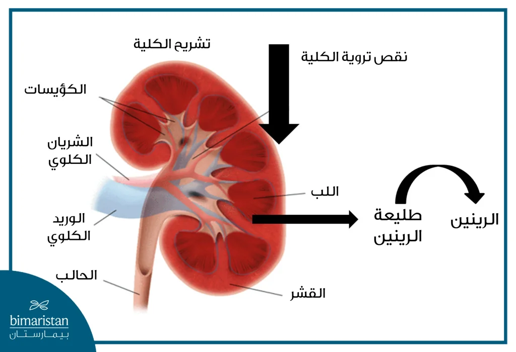 يحرض نقص تروية الكلية الناجم عن تضيق الشريان الكلوي تحول طليعة الرينين في الكلية إلى الرينين الذي يرفع الضغط