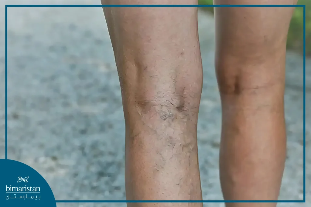 
Varicose Veins Appear Visibly On The Surface Of The Skin With A Blue Color When The Superficial Veins Become Enlarged.